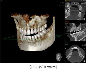 CT FOV 10x8cm