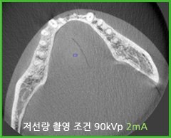 저선량 촬영 조건 90kVp 2mA