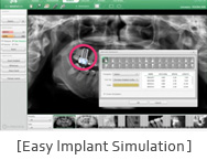 Easy Implant Simulation 화면
